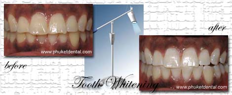 Tooth Whitening:Coldlight,non-LASER,LED,Natural Plus at Phuket Dental Clinic,Thailand